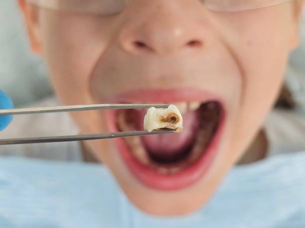 Best Pediatric Emergency Dentist in Gig Harbor, WA